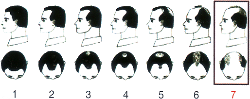 Male-Pattern Hair Loss